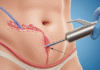 Liposuction – The Facts And The Myths Liposuction
