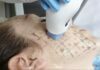 Know Benefits of Thermage CPT Thermage CPT