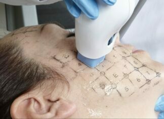 Know Benefits of Thermage CPT Thermage CPT