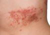 What causes Herpes Zoster Herpes Zoster