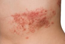 What causes Herpes Zoster Herpes Zoster