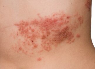 What causes Herpes Zoster Herpes Zoster