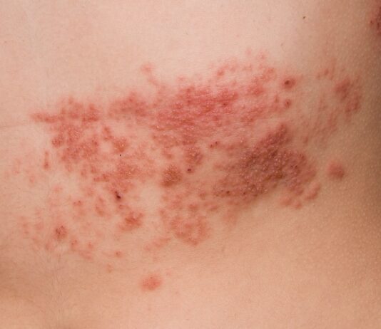 What causes Herpes Zoster Herpes Zoster
