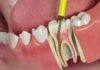 Emergency Root Canal Treatment Root Canal Treatment