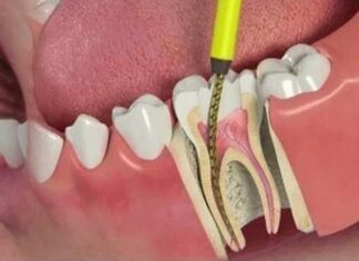 Emergency Root Canal Treatment Root Canal Treatment