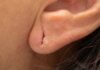 Jackson Heights Earlobe Repair: Improving Your Overall Look and Boosting Your Confidence Earlobe Repair