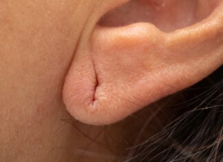 Jackson Heights Earlobe Repair: Improving Your Overall Look and Boosting Your Confidence Earlobe Repair