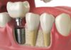 How To Prepare For The Dental Implant Procedure? Dental Implant