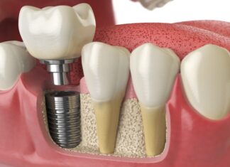 How To Prepare For The Dental Implant Procedure? Dental Implant