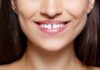 Is It Possible to Fix Gapped Teeth By Dental Veneers? Dental Veneers