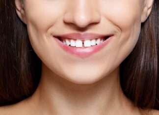 Is It Possible to Fix Gapped Teeth By Dental Veneers? Dental Veneers