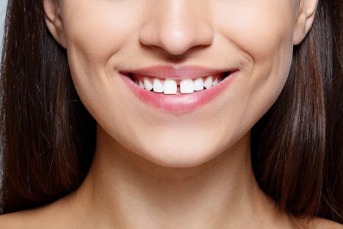 Dental Veneers