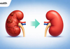 Before Choosing Kidney Transplant Surgery in Cairo, Egypt: Questions Every Patient Should Ask