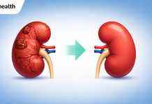 Before Choosing Kidney Transplant Surgery in Cairo, Egypt: Questions Every Patient Should Ask
