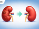 Before Choosing Kidney Transplant Surgery in Cairo, Egypt: Questions Every Patient Should Ask PAAAAA1BMVEWurq51dlI4AAAAAXRSTlMmkutdmwAAAA5JREFUKM9jGAWjYJABAAKUAAHoEAeuAAAAAElFTkSuQmCC